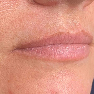 Lip Filler Before and After Photo by Coachlight Clinic & Spa in West Des Moines Iowa