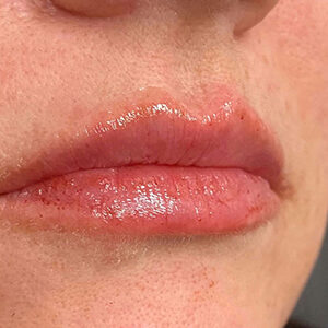 Lip Filler Before and After Photo by Coachlight Clinic & Spa in West Des Moines Iowa