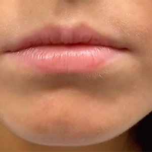 Lip Filler Before and After Photo by Coachlight Clinic & Spa in West Des Moines Iowa