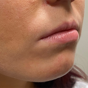 Lip Filler Before and After Photo by Coachlight Clinic & Spa in West Des Moines Iowa