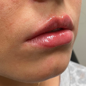 Lip Filler Before and After Photo by Coachlight Clinic & Spa in West Des Moines Iowa