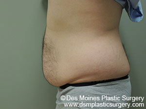 SmartLipo Before and After Photo by Coachlight Clinic & Spa in West Des Moines Iowa