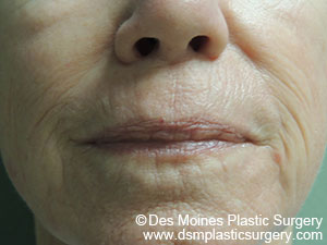 Laser Resurfacing Before and After Photo by Coachlight Clinic & Spa in West Des Moines Iowa