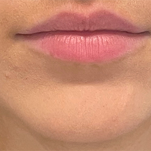 Lip Filler Before and After Photo by Coachlight Clinic & Spa in West Des Moines Iowa