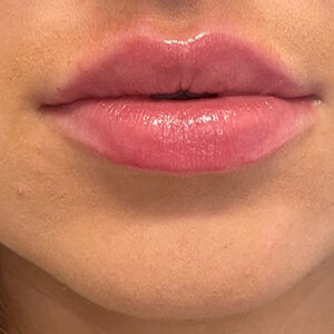 Lip Filler Before and After Photo by Coachlight Clinic & Spa in West Des Moines Iowa