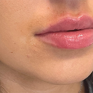 Lip Filler Before and After Photo by Coachlight Clinic & Spa in West Des Moines Iowa