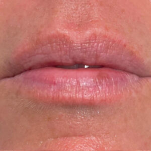 Lip Filler Before and After Photo by Coachlight Clinic & Spa in West Des Moines Iowa