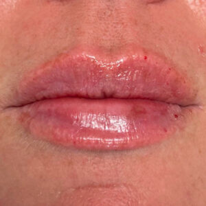 Lip Filler Before and After Photo by Coachlight Clinic & Spa in West Des Moines Iowa