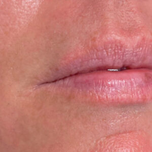 Lip Filler Before and After Photo by Coachlight Clinic & Spa in West Des Moines Iowa