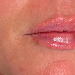 Lip Filler Before and After Photo by Coachlight Clinic & Spa in West Des Moines Iowa