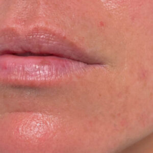 Lip Filler Before and After Photo by Coachlight Clinic & Spa in West Des Moines Iowa