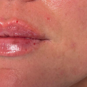 Lip Filler Before and After Photo by Coachlight Clinic & Spa in West Des Moines Iowa