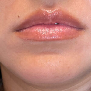 Lip Filler Before and After Photo by Coachlight Clinic & Spa in West Des Moines Iowa