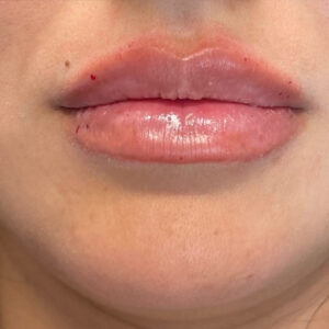 Lip Filler Before and After Photo by Coachlight Clinic & Spa in West Des Moines Iowa