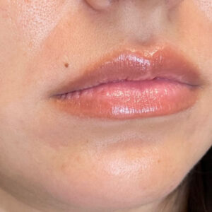 Lip Filler Before and After Photo by Coachlight Clinic & Spa in West Des Moines Iowa