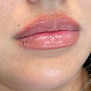 Lip Filler Before and After Photo by Coachlight Clinic & Spa in West Des Moines Iowa