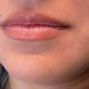 Lip Filler Before and After Photo by Coachlight Clinic & Spa in West Des Moines Iowa