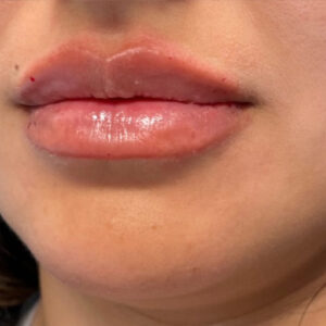 Lip Filler Before and After Photo by Coachlight Clinic & Spa in West Des Moines Iowa