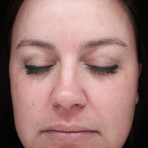 Halo treatment Before and After Photo by Coachlight Clinic Spa in West Des Moines Iowa
