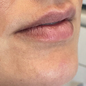 Lip Filler Before and After Photo by Coachlight Clinic & Spa in West Des Moines Iowa