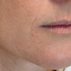 Lip Filler Before and After Photo by Coachlight Clinic & Spa in West Des Moines Iowa