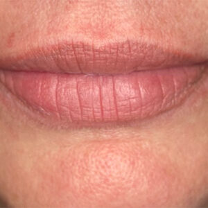 Lip Filler Before and After Photo by Coachlight Clinic & Spa in West Des Moines Iowa