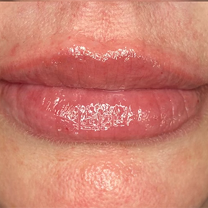 Lip Filler Before and After Photo by Coachlight Clinic & Spa in West Des Moines Iowa