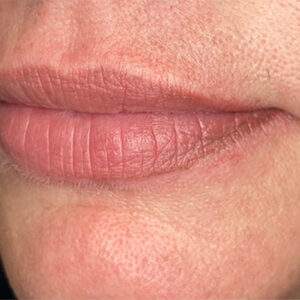 Lip Filler Before and After Photo by Coachlight Clinic & Spa in West Des Moines Iowa