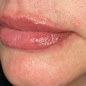 Lip Filler Before and After Photo by Coachlight Clinic & Spa in West Des Moines Iowa