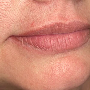 Lip Filler Before and After Photo by Coachlight Clinic & Spa in West Des Moines Iowa