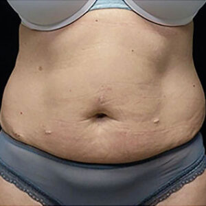 EMSCULPT Before and After Photo by Coachlight Clinic & Spa in West Des Moines Iowa