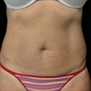 EMSCULPT Before and After Photo by Coachlight Clinic & Spa in West Des Moines Iowa