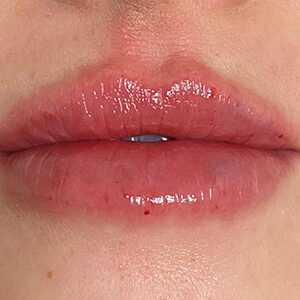 Lip Filler Before and After Photo by Coachlight Clinic & Spa in West Des Moines Iowa