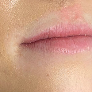 Lip Filler Before and After Photo by Coachlight Clinic & Spa in West Des Moines Iowa