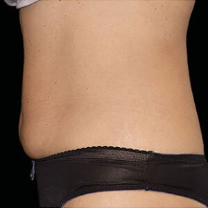 EMSCULPT Before and After Photo by Coachlight Clinic & Spa in West Des Moines Iowa