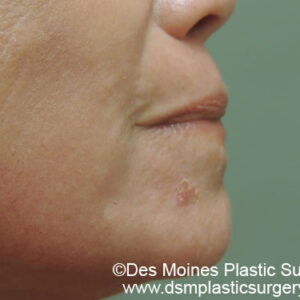 Laser Resurfacing Before and After Photo by Coachlight Clinic & Spa in West Des Moines Iowa