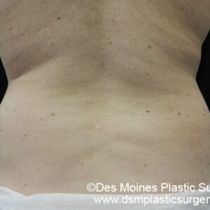 CoolSculpting Before and After Photo by Coachlight Clinic & Spa in West Des Moines Iowa