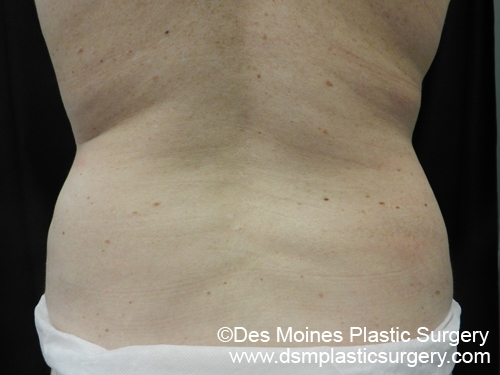 CoolSculpting Before and After Photo by Coachlight Clinic & Spa in West Des Moines Iowa