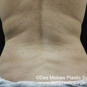 CoolSculpting Before and After Photo by Coachlight Clinic & Spa in West Des Moines Iowa