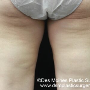 CoolSculpting Before and After Photo by Coachlight Clinic & Spa in West Des Moines Iowa