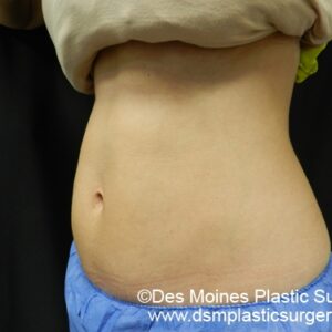 CoolSculpting Before and After Photo by Coachlight Clinic & Spa in West Des Moines Iowa