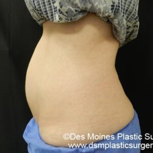 CoolSculpting Before and After Photo by Coachlight Clinic & Spa in West Des Moines Iowa