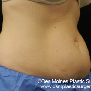 CoolSculpting Before and After Photo by Coachlight Clinic & Spa in West Des Moines Iowa