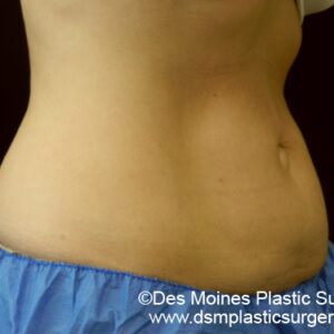 CoolSculpting Before and After Photo by Coachlight Clinic & Spa in West Des Moines Iowa