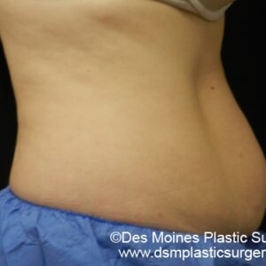 CoolSculpting Before and After Photo by Coachlight Clinic & Spa in West Des Moines Iowa