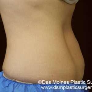 CoolSculpting Before and After Photo by Coachlight Clinic & Spa in West Des Moines Iowa