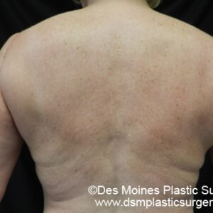 CoolSculpting Before and After Photo by Coachlight Clinic & Spa in West Des Moines Iowa