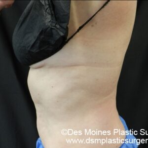 CoolSculpting Before and After Photo by Coachlight Clinic & Spa in West Des Moines Iowa