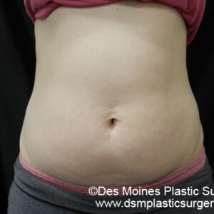 CoolSculpting Before and After Photo by Coachlight Clinic & Spa in West Des Moines Iowa