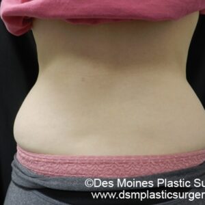 CoolSculpting Before and After Photo by Coachlight Clinic & Spa in West Des Moines Iowa